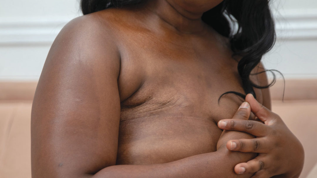 Keisha exposing radical mastectomy scar